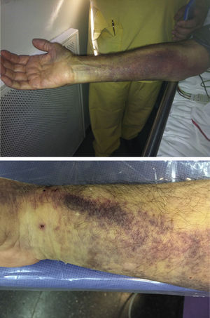 Two images of ecchymosis and hematomas after radial catheterization.