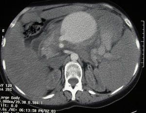Aneurysm of the splenic artery on abdominal CT scan.