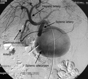 Aneurysm of the splenic artery on angiography.
