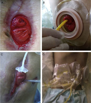 (A) Enterocutaneous fistula; (B) distal fistulous orifice canalized with a gastrostomy tube; (C) proximal fistulous orifice indicated with forceps; and (D) collection and infusion system using a physiological model.