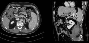 Abdominopelvic CT scan: functional pancreatic remnant of the tail with the dilated duct in its interior, disconnected from the rest of the gland (white arrow).