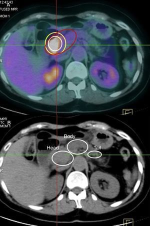 (A) Tumor uptake in PET-CT: the white line represents the tumor area; the yellow is the perilesional area; the red is the area of the affected pancreas, in this case the head of the pancreas; (B) representation of the different parts of the pancreas on CT.