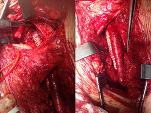 Procedure for extension of surgical margins with resection of femoral vein and reconstruction using an end-to-end PTFE graft with proximal anastomosis in the external iliac vein (A: left retroperitoneal space) and distal in the common femoral vein (B: left inguinal region).