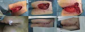 Surgical images of the 3 patients, before and after reconstruction: (A1 and B1) patient 1, (A2 and B2) patient 2, and (A3 and B3) patient 3.