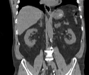 CT reconstruction showing evidence of a left adrenal mass.