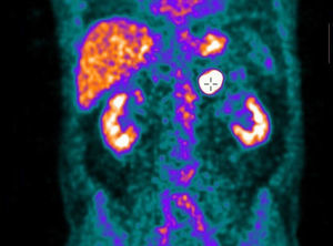 PET-CT showing evidence of the elevated metabolic activity of the adrenal mass.