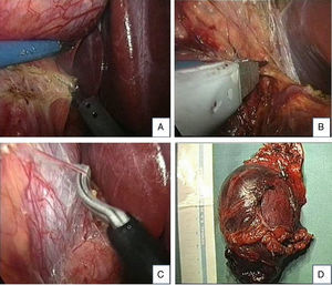 (A) Laparoscopic image showing the opening of the parietal peritoneum and renal fascia, (B) placement of a clip on the upper vessels, (C) Kocher manoeuvre and dissection of the inferior vena cava, and (D) Surgical specimen.