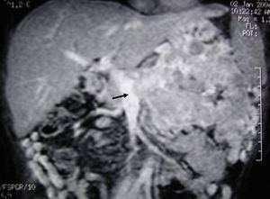 MRI image of liver: 3D T1 sequence coronal reconstruction with fat suppression and intravenous contrast in the portal phase demonstrating a voluminous pancreatic tumour lesion compatible with a neuroendocrine tumour with splenic and renal infiltration. The tumour thrombus in the splenic vein is observed (arrow) to be protruding towards the lumen of the superior mesenteric vein. At the time of diagnosis (January 2004), the patient was 39 years old; surgical treatment included distal pancreatectomy with resection of the portomesenteric venous confluence, splenectomy, left hemicolectomy and left nephrectomy. Currently (May 2016), the patient is alive and without relapse after 12 years of follow-up.