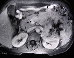 MRI image of the liver (same clinical case as Fig. 1): 3D T1 axial image with fat suppression and intravenous contrast that shows the neuroendocrine tumour of the body-tail of the pancreas and the tumour thrombosis of the splenic vein (arrow). The voluminous gastroepiploic vein (asterisk) translates segmental portal hypertension.