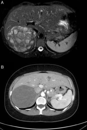 (A) Magnetic resonance image identifying a well-defined right adrenal mass, measuring 11×7.5cm in diameter; (B) computed tomography image demonstrating a well-outlined adrenal mass that had not increased in size compared to the previous MRI study.