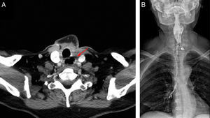 (A) Computed tomography: air space corresponding with a cervical oesophageal defect (arrow). (B) Oesophageal videofluoroscopic swallow study showing contrast extravasation through the cervical oesophageal fistula, with no passage to the distal oesophagus, and aspiration of the contrast to both main bronchi.