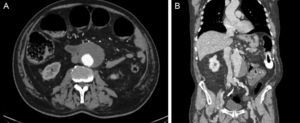 CT scan showing infrarenal AAA and bowel dilatation due to occlusive neoplasia of the descending colon (A: axial, B: coronal).
