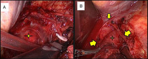 (A) Ligature of multiple vascular pedicles dependent on the intercostal and direct aortic vessels. The tumor was drawn forward (star). The diaphragm, whitish in color, is at the right side of the image. (B) Dissection of the lower pole of the tumor (star) prior to opening the crura of the diaphragm (inverted V-shape; the dissection angle or end is marked with the smaller arrow and the edges with the larger arrows).