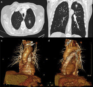 Computed tomography angiography showing a solitary lung nodule in the left upper lobe: (a) axial; (b) coronal. Volumetric reconstructions showing the complex web of bilateral pulmonary vascularization and the nodule in the left upper lobe: (c) anterior view; (d) left lateral view.