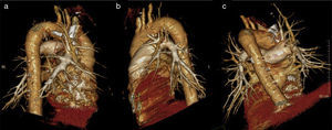 Volumetric reconstruction showing the rotational capability of the images: (a) right lung vascularization pattern, lateral view; (b) left lung vascularization pattern, lateral view and (c) pulmonary vascularization pattern, posterior view.