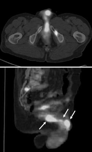 18F-FDG PET/CT scan. Selected images show increased FDG metabolism in the penile and glans metastases (arrows) and in multiple bone metastases.