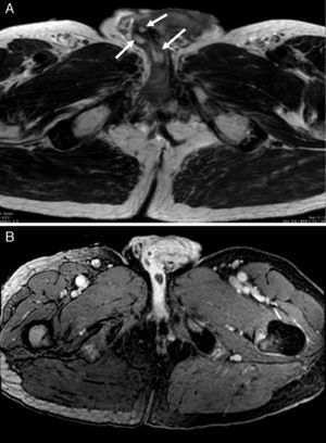 Penile magnetic resonance image. T1-weighted imaging shows lesions in the corpora cavernosa and glans (arrows) (A). After gadolinium administration, penile lesions shows peripheral enhancement (B).