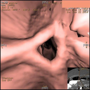 Virtual colonoscopy showing stenosis in the sigmoid colon.