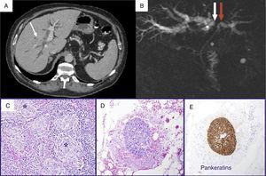 (A) CT: dilatation of the intrahepatic bile duct (asterisk); infiltrating lesion surrounding the bile duct (arrow); (B) MRCP: dilatation of the intrahepatic bile duct with occlusion of the right branch (white arrow) and stenosis of the left (red arrow); common bile duct of normal size (asterisk); (C) detail of the sarcoid-type non-necrotizing epithelioid granulomas (*); (D) embolus of atypical epithelial cells in the interior of a perilymphatic vessel; the positivity for keratins (AE1-AE3) confirms its epithelial nature (E).