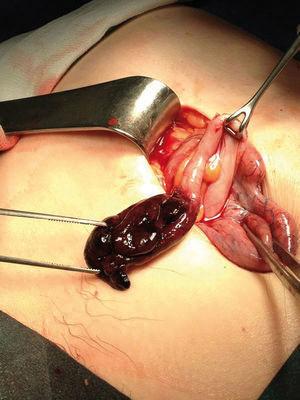 A femoral hernia is observed, containing a partially necrotic vermiform appendix, with no involvement of its base, showing hematoma in the mesoappendix and no local signs of infection.