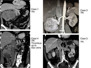 Renal tumors with thrombosis of the inferior vena cava (cases 1, 2, 4 and 5) with levels IIIa, IIIb and IIIc, according to the Ciancio et al. classification.11