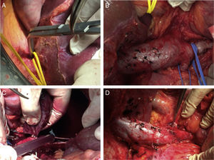 (A) Dissection of the suprahepatic vena cava; (B) piggy-back and dissection of the renal veins and infrarenal vena cava; (C) cavotomy and extraction of the thrombus; (D) cavography.
