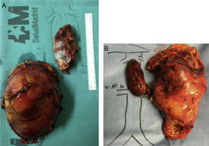 (A) Right renal tumor with thrombosis of the cava (IIIb); and (B) left renal tumor with thrombosis of the cava (IIIc).