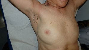 Axillary scar and initial location of the mass (circle); no pathological alterations were detected on physical exploration, except for induration in the right axilla compatible with scarring.
