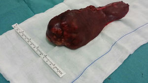 Surgical specimen from left hepatectomy containing the tumor (posterior view).