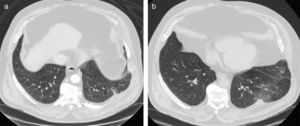(a) Initial thoracic CT scan demonstrating the protrusion of the lung parenchyma between the left 9th and 10th ribs; (b) follow-up CT, with the image of the lung hernia recurrence between the left 8th and 9th ribs.
