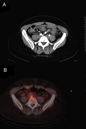 Abdominal computed tomography identifying tumor lesion in the area of L5 (white arrow), medial to the bifurcation of the right iliac artery (A); SPECT/CT showing uptake of 123I-MIBG, confirming the diagnosis of paraganglioma (B).