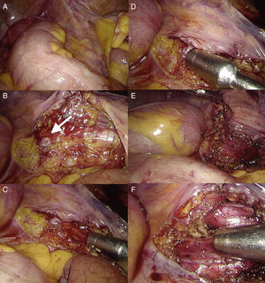 Laparoscopic image of the right iliac vessels (A) and uncertain identification of the lesion after dissection (B); gamma probe confirmed the pathologic uptake of the lesion compared with the surrounding tissue (C and D). Complete resection of the tumor was achieved (E). The gamma probe was used for the confirmation of the complete resection, with no evidence of uptake in the surrounding tissue (F).