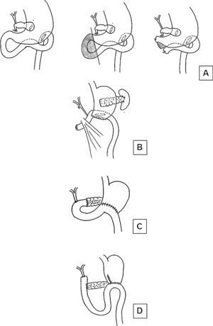 Surgical diagram showing different reconstruction techniques after PD: (A) Original Whipple technique in 2 stages; (B) Reconstruction by Leopoldo Domínguez from the first description of a PD in Spain; (C) Technique used by Pi-Figueras and Vicens Artigas; (D) Technique most frequently used by Luis Estrada.