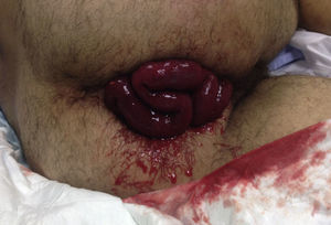 Transanal evisceration of the small bowel in the emergency room.