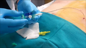 Placement of PPP insufflation catheter