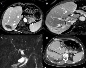 (A) Metastasis in segment 7; (B) infiltration of the right posterior bile duct (arrow indicating infiltration limit 21mm from the anterior duct); (C) MRCP with no dilatation or stenosis; (D) volume CT on the 7th day post-op after the first stage