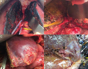 (A) 1st stage: partition of the liver along the Cantlie line; vessel loop on the artery; (B) 2nd stage: external biliary drains; (C) liver remnant; (D) resection specimen: black arrow indicating the tumor in the bile duct, white arrow indicating bile resection margin.