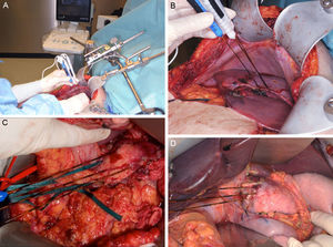 Images (A) and (B) show an example of the intraoperative placement of the electrodes for ablation of a hepatic lesion using the open approach. A closer look at the placement of the electrodes for the ablation of a lesion depending on its location in the neck/body of the pancreas (C) or the head (D). Images provided by Dr. ML de Oliveira.