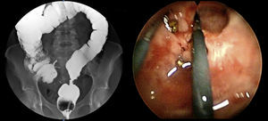Stenosis of a colorrectal anastomosis: to the left, barium enema showing difficult passage at the upper rectum; to the right, TEM image during resection of the stenotic ring.