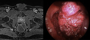 Left: magnetic resonance image (sequence T2) of a retrorectal cyst. Right: during removal by TEM, open rectal wall and bilobar morphology can be observed.