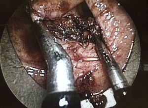 Examination of the lesion of the anterior rectum.