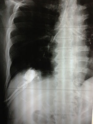 Chest radiograph: the instillation of water-soluble contrast material in the hepatic drain tube is seen in the airway.