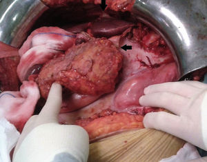 Intraoperative image showing a pearly-white fibrous membrane encompassing part of the organs of the abdominal cavity. The arrows indicate the edges of this membrane after having been dissected to facilitate the surgical procedure.
