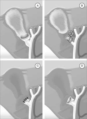 Types of subtotal cholecystectomy: (A) preservation of the posterior wall of the gallbladder with open remnant; (B) preservation of the posterior wall of the gallbladder with closed remnant; (C) closure of the gallbladder remnant without preservation of the posterior wall; (D) open gallbladder remnant without preservation of the posterior wall.