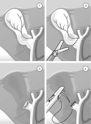 Surgical technique of laparoscopic subtotal cholecystectomy: (1) there is no critical vision after adequate dissection; (2) dissection at the infundibulum; (3) identification of remaining calculi under direct vision, followed by extraction; (4) closure of the infundibulum with suture and extracorporeal knot-tying.
