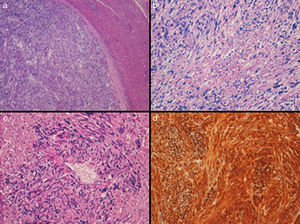 (a) Solid encapsulated neoplasm that is well outlined from the adjacent liver parenchyma (H-E, 4×); (b) It is constituted by intertwining bundles of spindle cells with marked nuclear atypia, atypical mitotic figures and a focus of necrosis (H-E, 10×); (c) Neoplastic cells emerging from the wall of a small hepatic vessel (H-E, 20×); (d) Intense positivity of tumor cells (desmin 20×).