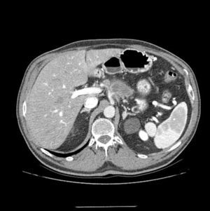 Multidetector computed tomography scan: tumor mass is evident in the neck/body of the pancreas, encompassing the splenic artery and in contact with the hepatic and celiac arteries. At the time of diagnosis, a second tumor mass was identified in the head of the pancreas; therefore, the two-stage surgical plan included total pancreaticoduodenectomy, four/fifths gastrectomy, splenectomy, celiac trunk resection and end-to-end arterial anastomosis after arterial embolization.