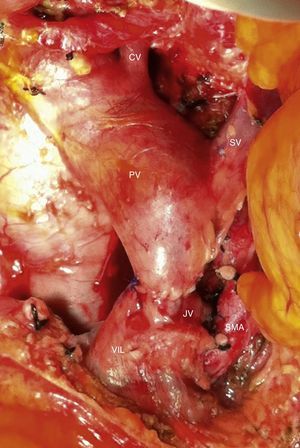 Intraoperative image after resection of borderline-resectable pancreatic adenocarcinoma with obliteration of the superior mesenteric vein and PV. The image shows the end-to-end venous anastomosis between the SMV and the confluence of the ileocolic vein and the JV. SMA: superior mesenteric artery; CV: coronary vein; SV: splenic vein; PV: portal vein; JV: jejunal vein.