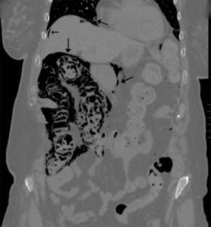 Coronal CT image: presence of pneumomediastinum, pneumoperitoneum, retropneumoperitoneum and gas in the wall of the right colon.