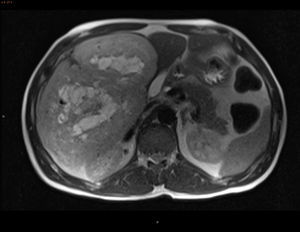 MRI: T2-weighted sequence of the axial plane showing a large well-outlined mass, exophytic, dependent on liver segments V-VI, with a compressive effect on extrahepatic structures yet no apparent infiltration and with an extensively necrotic central area or cystic degeneration.